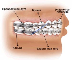 Устройство брекетов