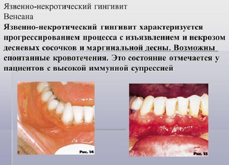 Гингивит Венсана