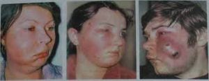 Флегмона верхней челюсти