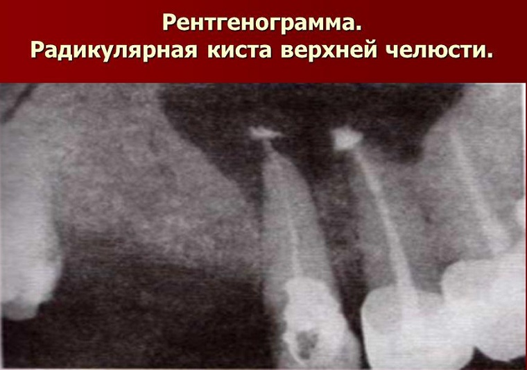 радикулярная киста на рентгене