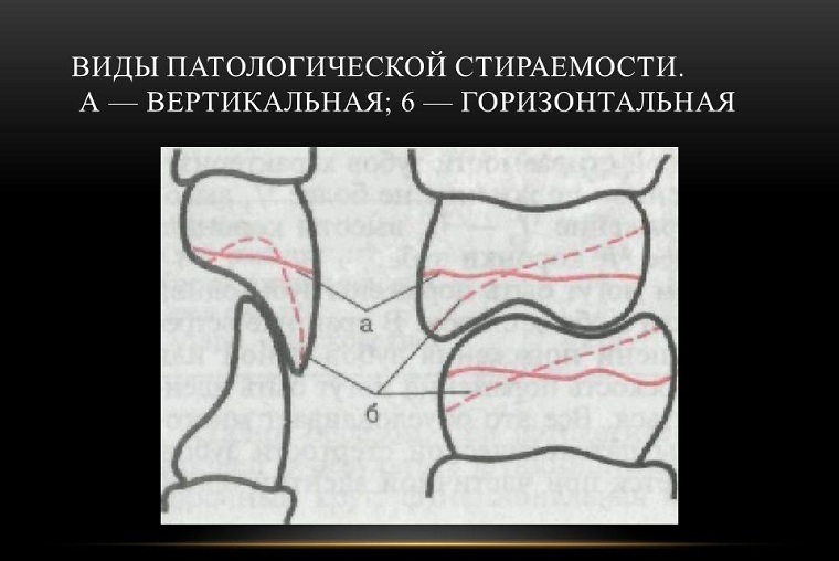 виды стираемости зубов