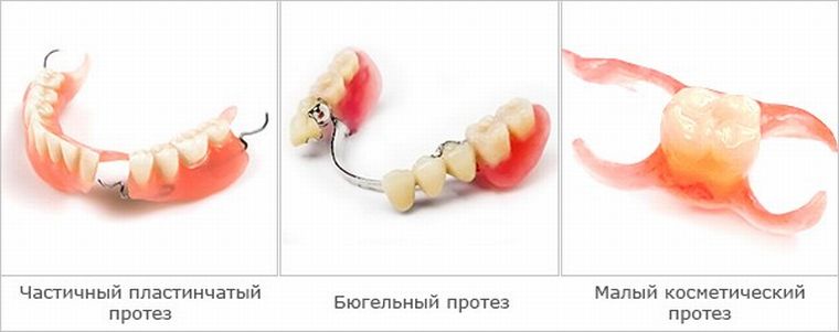 Виды протезов