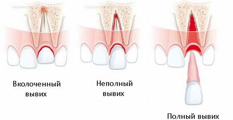 виды вывихов зуба