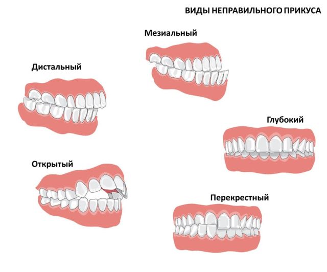 Виды неправильного прикуса
