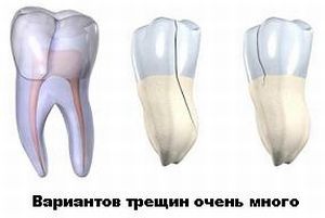 виды зубных трещин