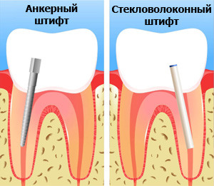 анкерный и стекловолоконный штифт