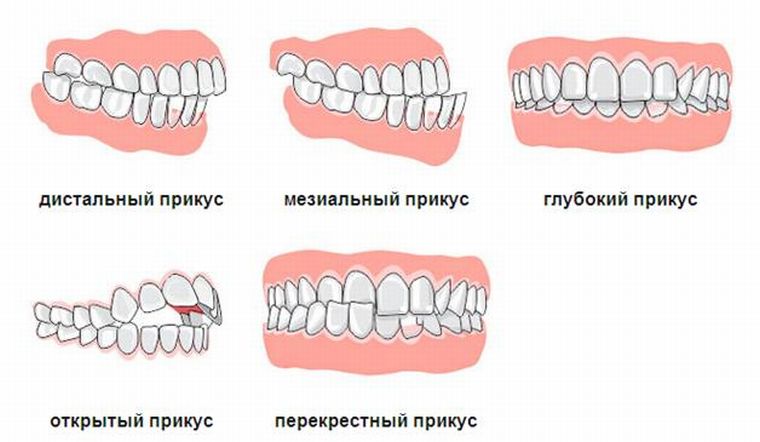 Виды неправильного прикуса