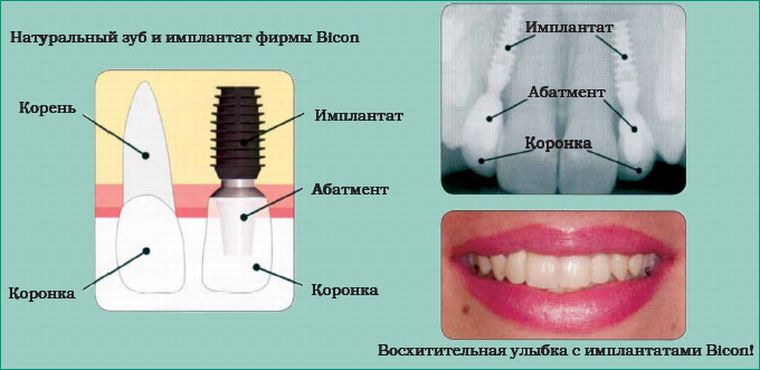 Установленный имплант и зуб