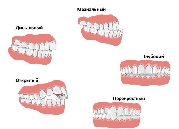 виды неправильного прикуса