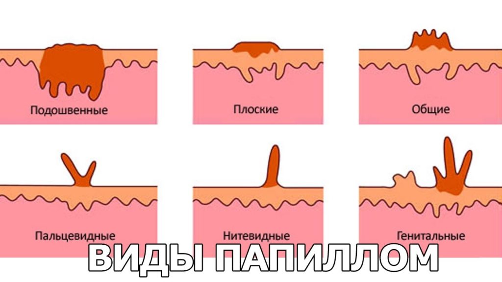 Виды бородавок