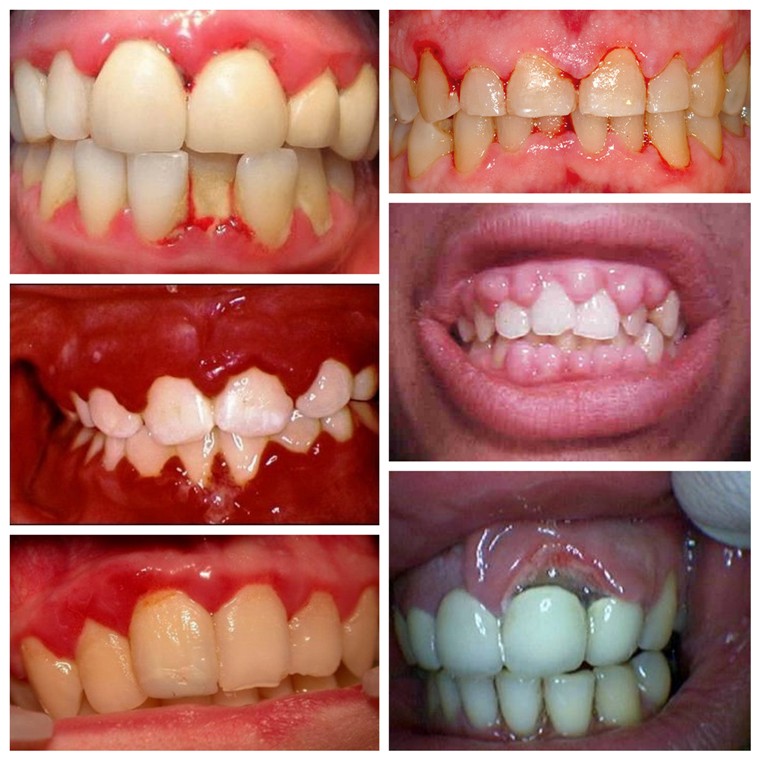 воспаление
