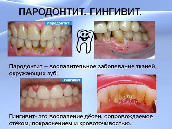 Пародонтит и гингивит