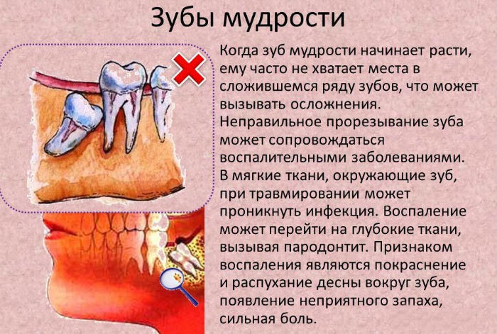 воспаление десны над зубом мудрости