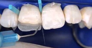 Реставрация зуба