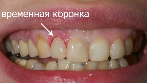 временная коронка
