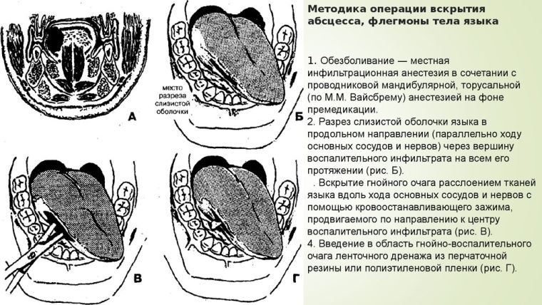 Вскрытие абсцесса на языке