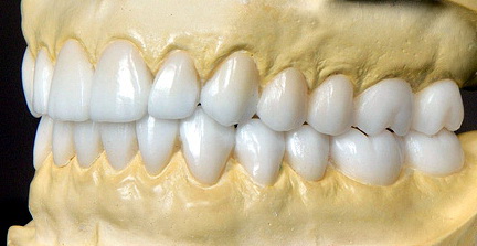 Wax-up