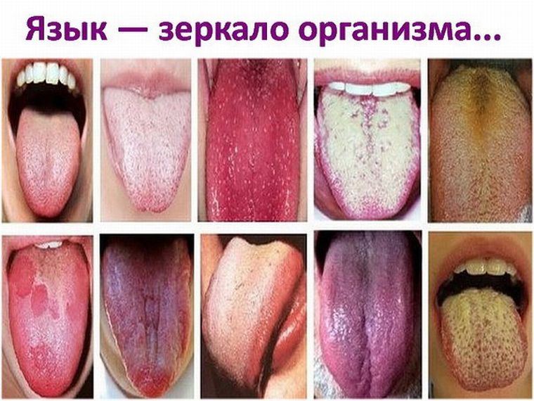 Язык зеркало болезней