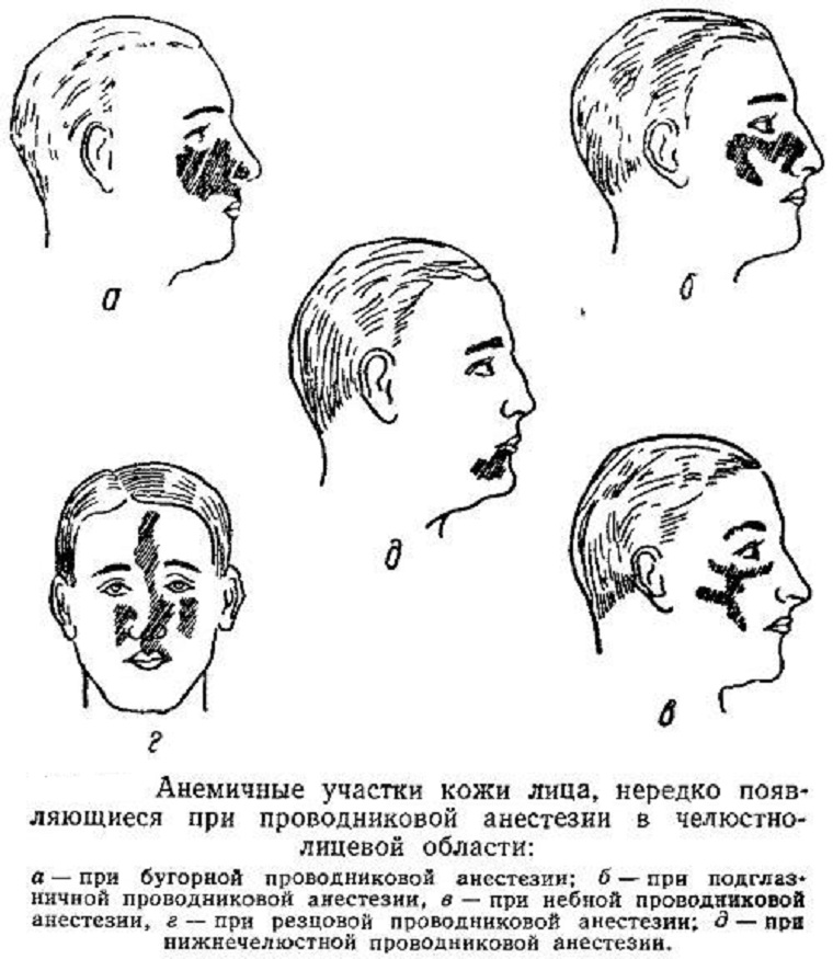 Зона обезболивания при проводниковой анестезии