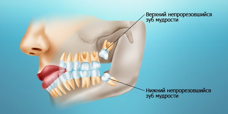 зубы мудрости
