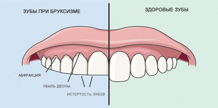 Зубы при бруксизме
