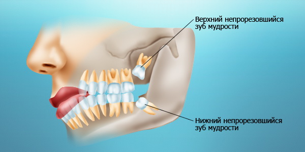 зубы мудрости - особенности прорезывания